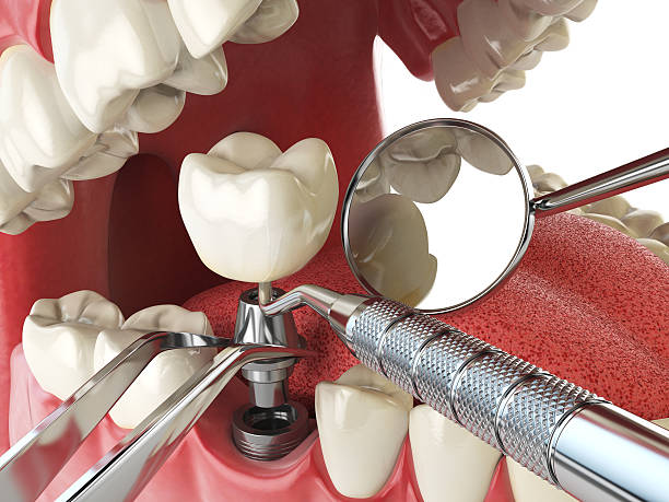 Best Urgent Tooth Repair  in Venice, FL